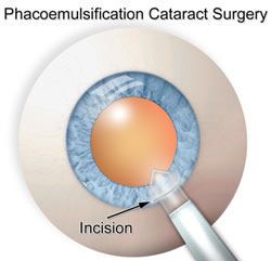 cataract surgery incision scratchiness post op cataract surgery incision scratchy